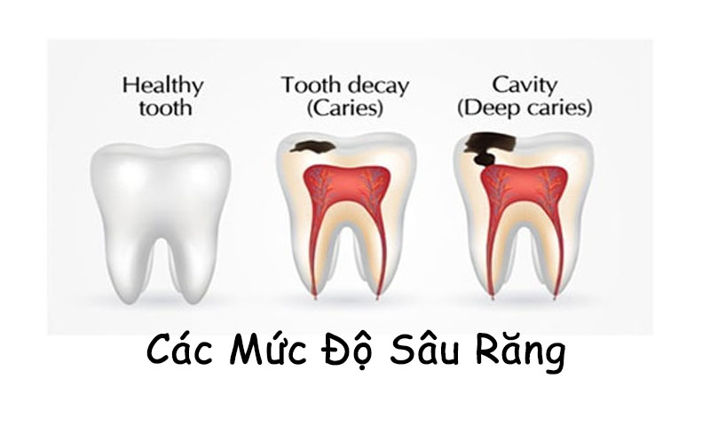 Các mức độ sâu răng