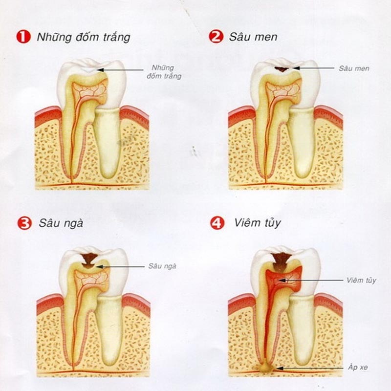  Các giai đoạn của sâu răng