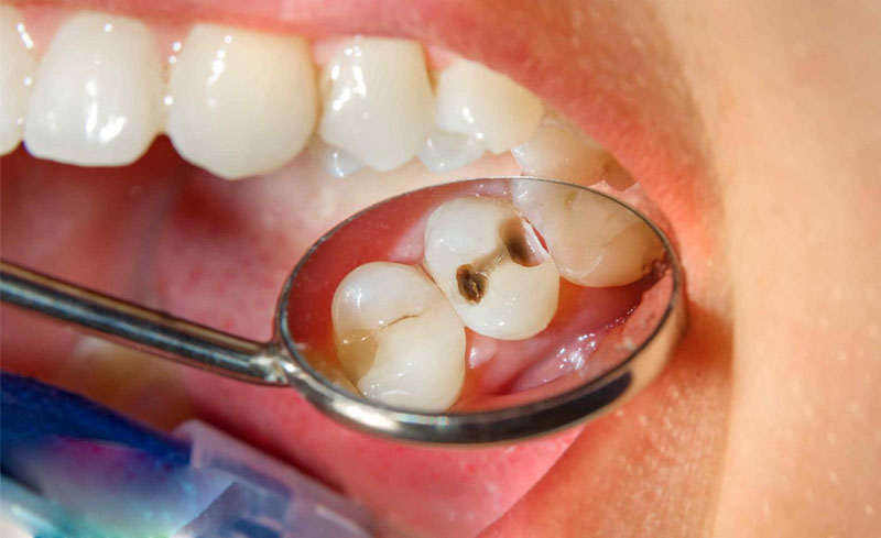 Cách nhận biết sâu răng chính xác nhất là dựa vào dấu hiệu lạ trên bề mặt răng