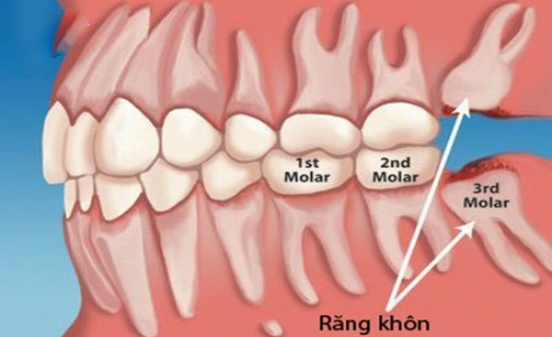 Vị trí của răng số 8 trong hàm.