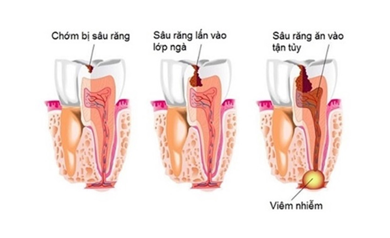 Quá trình sâu răng ăn vào tủy