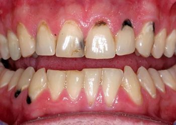 Bệnh sâu răng có chữa khỏi được không là câu hỏi nhiều người quan tâm.