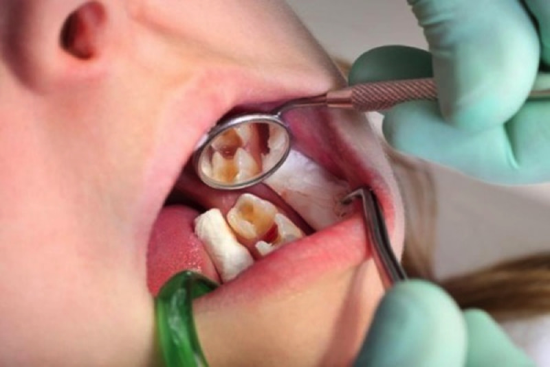 Sâu răng là bệnh lý gây ra hiện tượng đau lợi sưng hạch