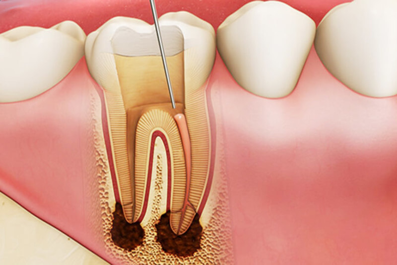 Bị áp xe răng có nguy hiểm không còn dựa vào quá trình rút tủy răng của các bác sĩ