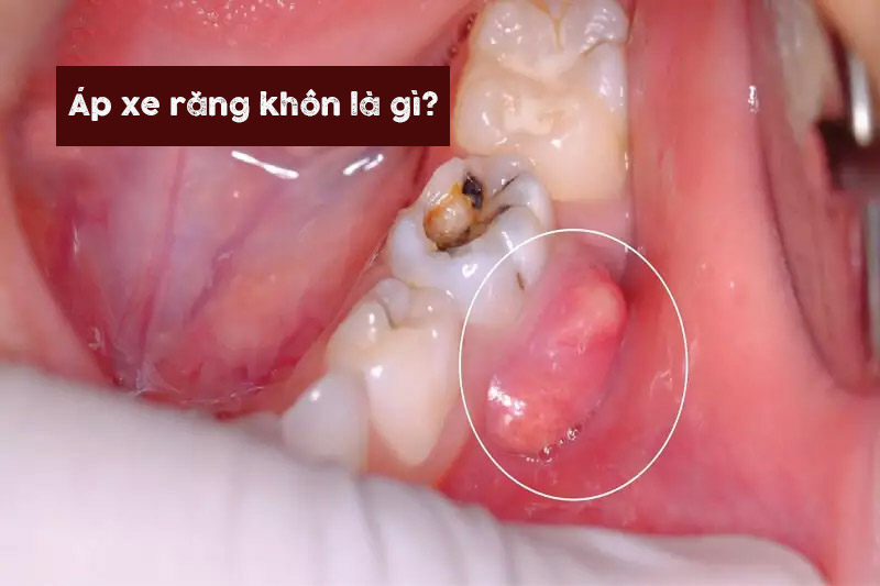 Áp xe răng khôn là hiện tượng răng bị nhiễm khuẩn mưng mủ sưng tấy.