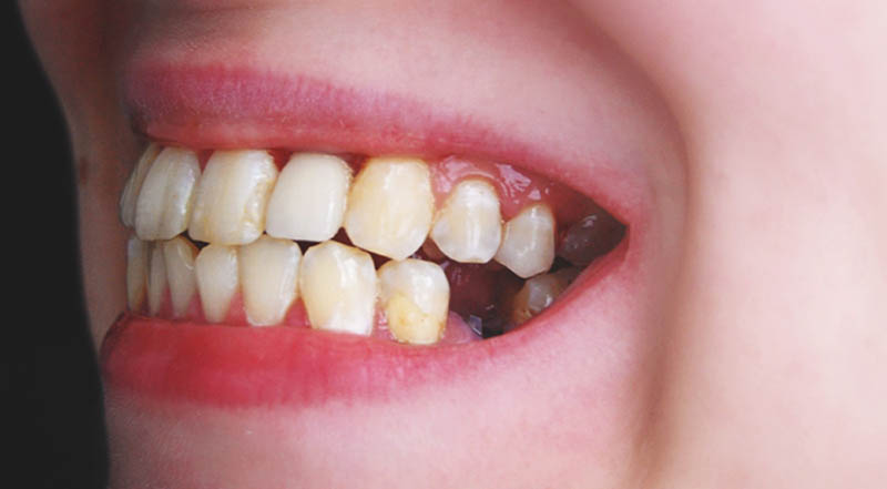 Vệ sinh răng miệng không đúng cách là nguyên nhân chính gây bệnh