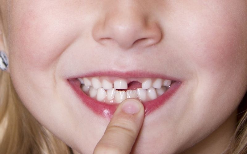 Không nên cưỡng ép nhổ răng sớm 