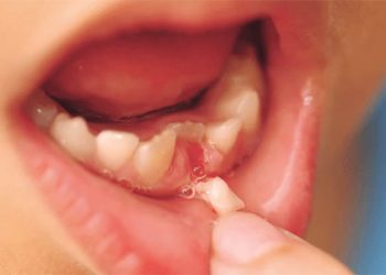 Có nên nhổ răng sữa chưa lung lay của trẻ hay không?