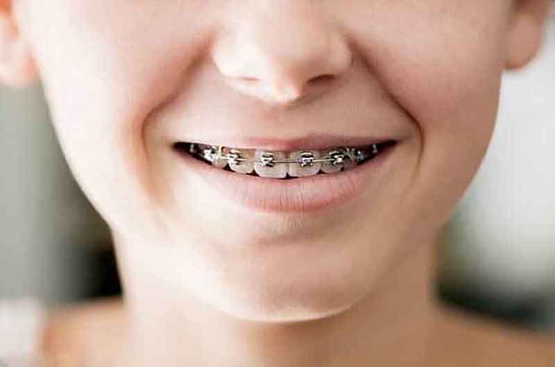 Trong nhiều trường hợp, nha sĩ sẽ khuyên phụ huynh cho trẻ niềng răng sớm