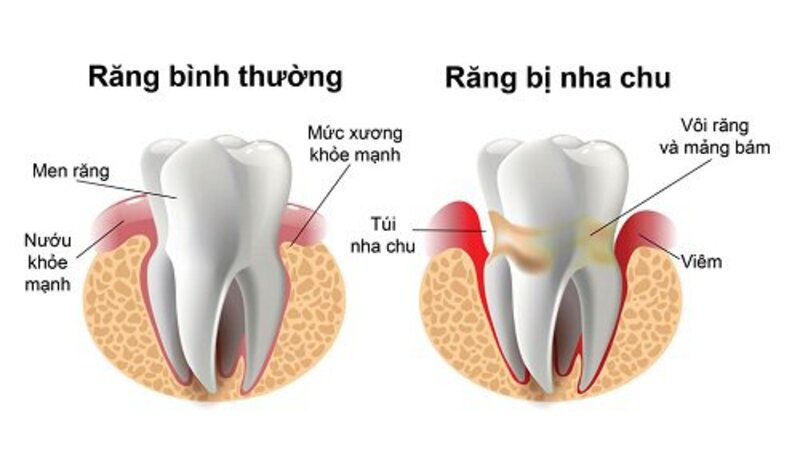 Đây bệnh lý viêm nhiễm vùng nướu làm tổn thương nghiêm trọng đến mô mềm và phá hủy xương hàm