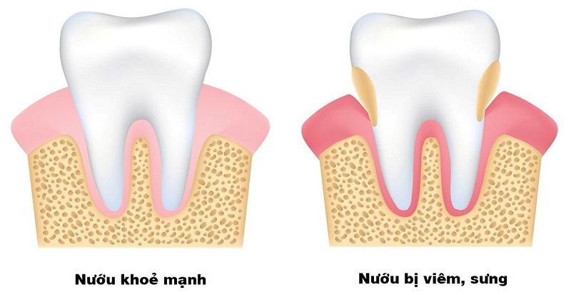 Viêm nha chu mãn tính ảnh hưởng nghiêm trọng tới sức khỏe người bệnh