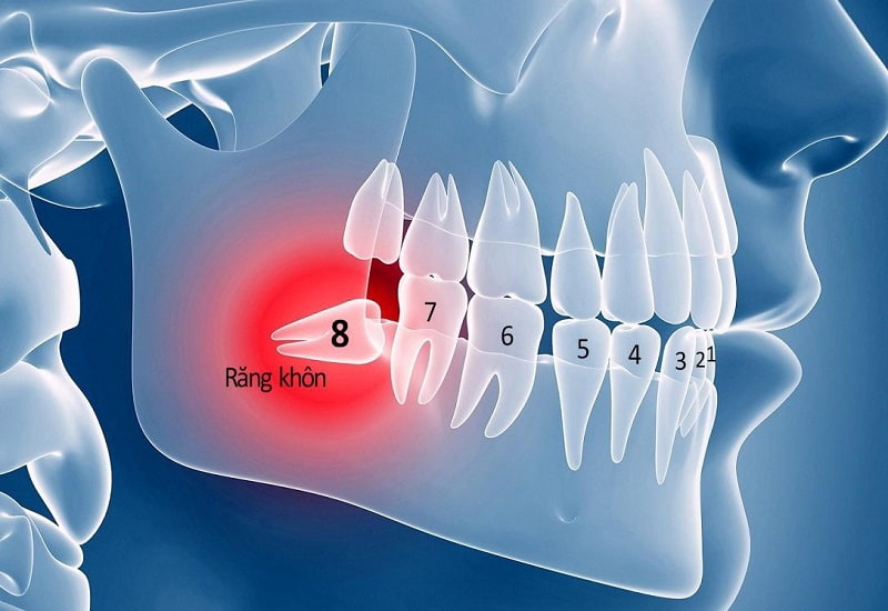 Trường hợp mọc lệch, chèn ép sẽ được xem xét để nhổ bỏ.