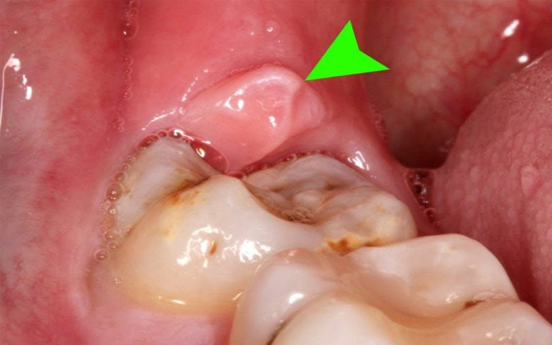 Mọc răng khôn là nguyên nhân phổ biến dẫn đến đau răng sưng má