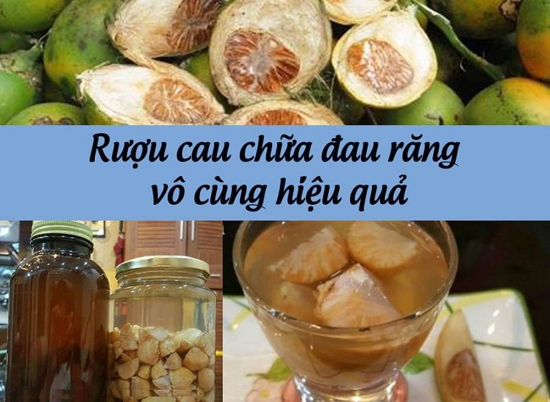 Rượu cau mang đến công dụng chữa đau răng hiệu quả, được nhiều người áp dụng