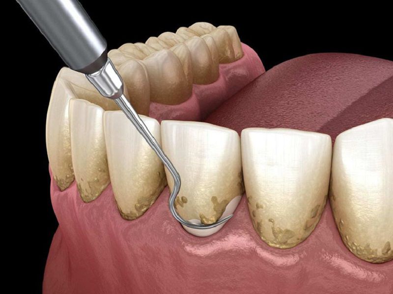 Vôi răng cần được loại bỏ bằng dụng cụ chuyên khoa