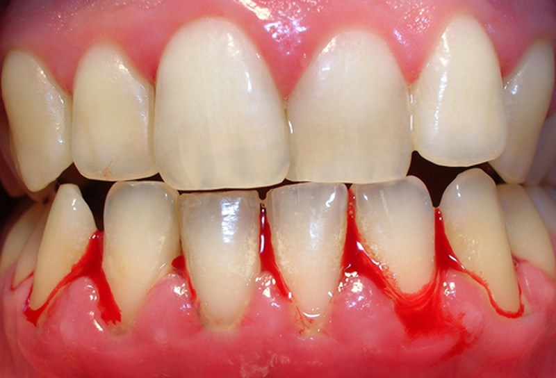 Phần lợi bị chảy máu là biểu hiện nặng của bệnh lý răng miệng