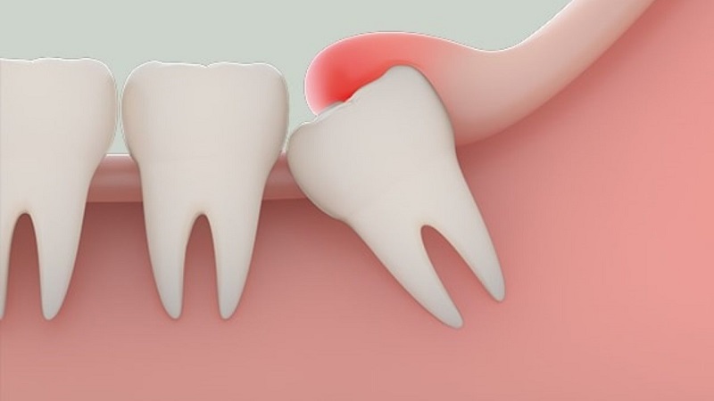 Răng khôn là gì, có ảnh hưởng đến răng miệng ra sao là băn khoăn của nhiều người