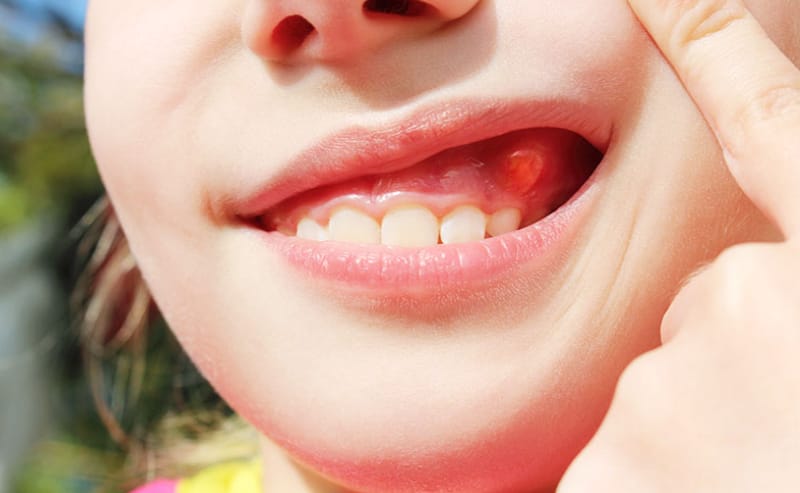 Các nang răng thường bắt nguồn từ nhiễm trùng chân răng