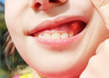 Nang răng và những thông tin quan trọng không nên bỏ lỡ