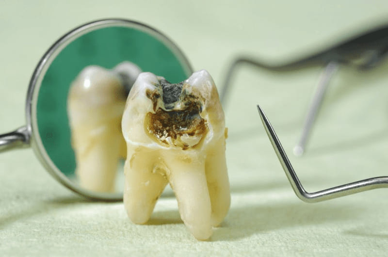 Khi răng bị sâu quá nặng, cần thực hiện nhổ bỏ
