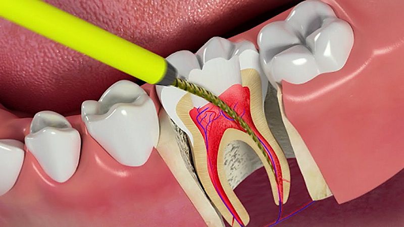 Tủy được bao bọc bởi lớp ngà răng và men răng