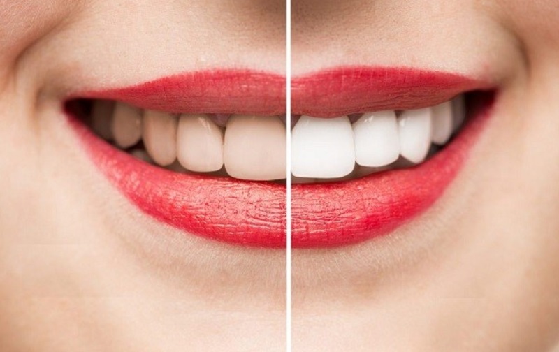 Tẩy trắng răng là gì? Các phương pháp phổ biến và quy trình thực hiện