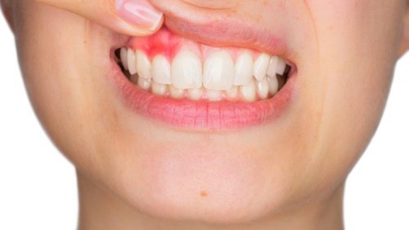 Áp xe quanh chân răng là một bệnh lý khá nguy hiểm do biến chứng viêm tủy răng gây nên