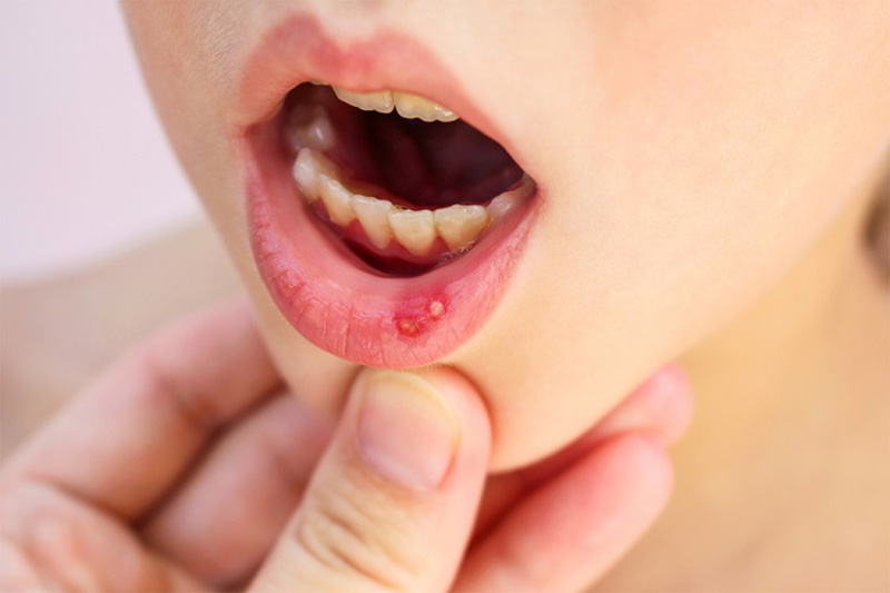 Thuốc nhiệt miệng Peridex có thể sử dụng cho trẻ từ 2 tuổi trở lên