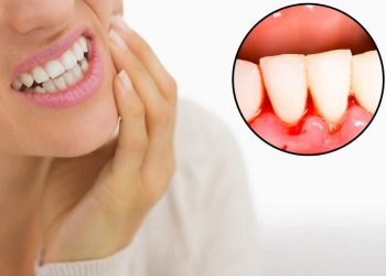 Viêm chân răng kiêng ăn gì