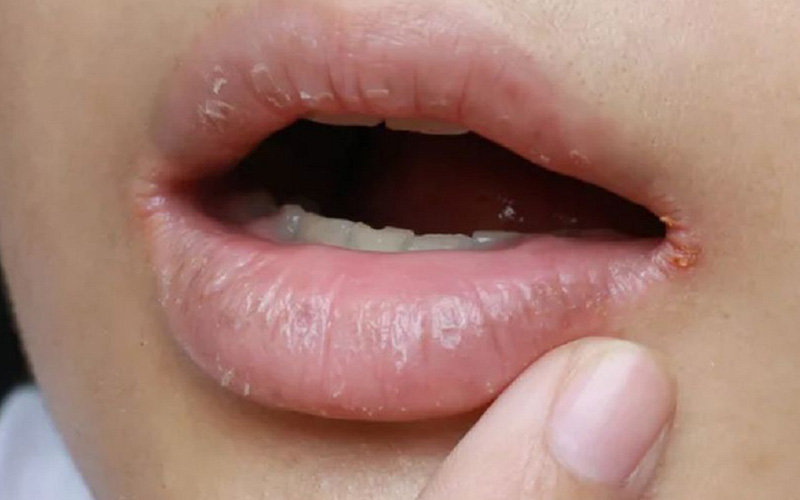 Nấm gây chảy máu ở khỏe miệng của người mắc
