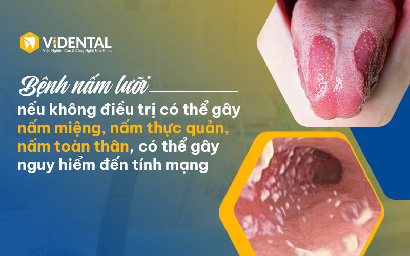 ViDental Care là địa chỉ điều trị nấm lưỡi uy tín 