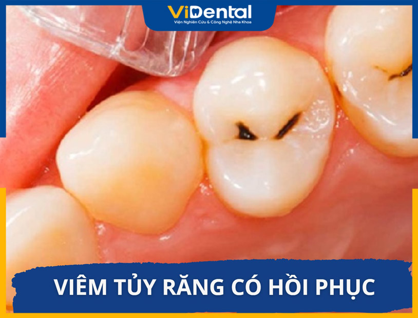 Viêm tủy răng có hồi phục