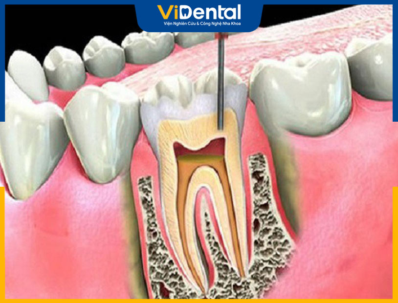 Sâu răng và viêm tủy dẫn đến viêm cuống chân răng