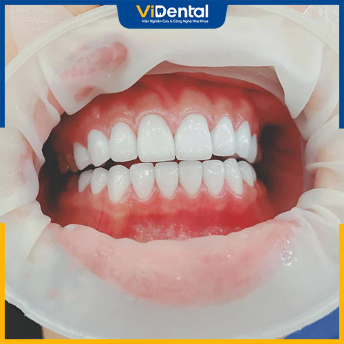 Làm răng sứ là dịch vụ nổi bật của phòng khám nha khoa PT