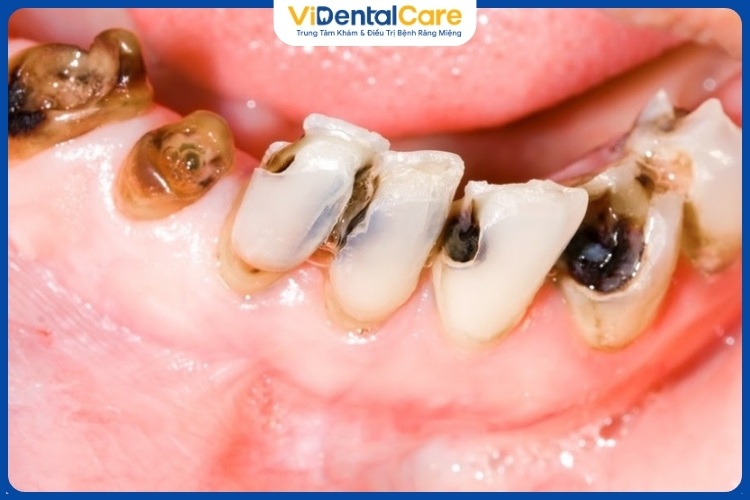 Vệ sinh răng miệng kém và vi khuẩn là nguyên nhân chính gây sâu răng