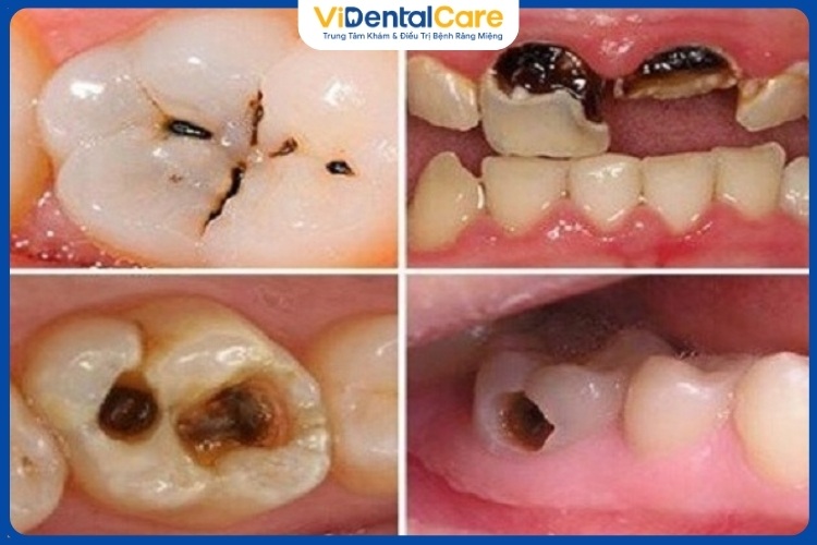 Dấu hiệu sâu răng phát triển nghiêm trọng theo thời gian