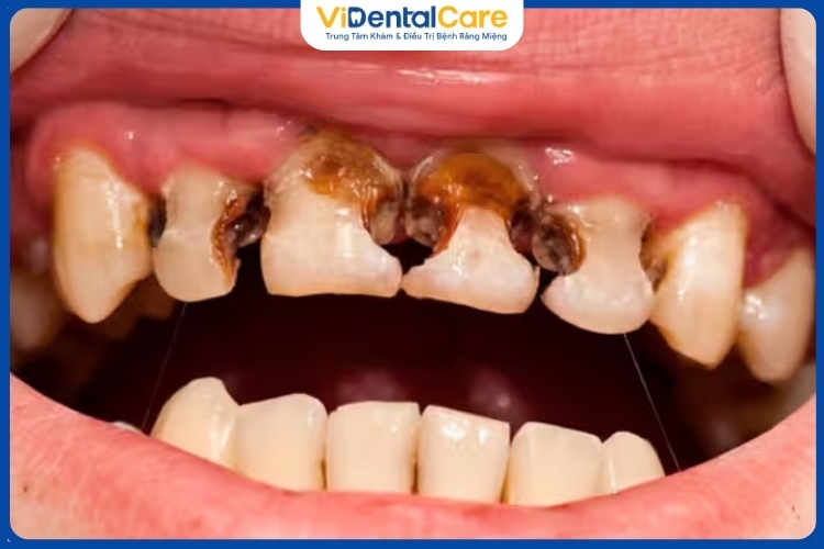Sâu răng gây nhiều ảnh hưởng tiêu cực trong sinh hoạt và cuộc sống