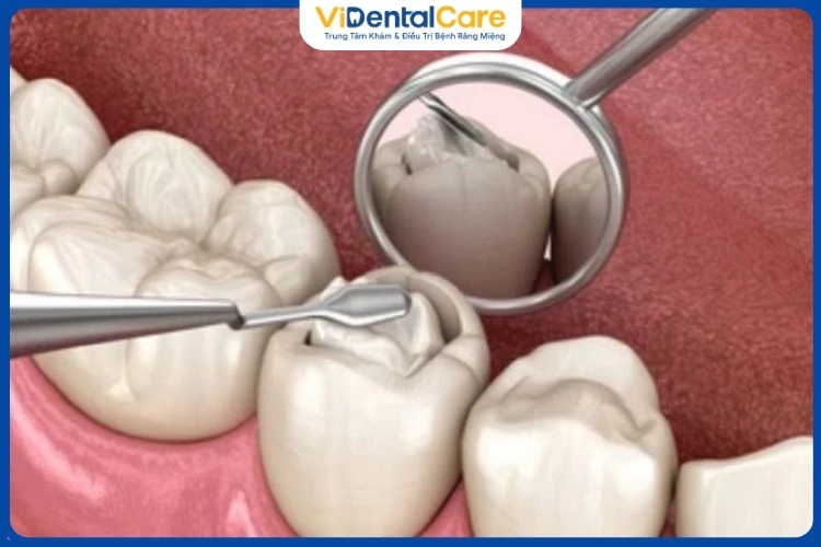 Trám răng sâu là phương pháp mang lại hiệu quả điều trị tốt