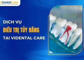 Dịch vụ điều trị tủy răng tại ViDental Care