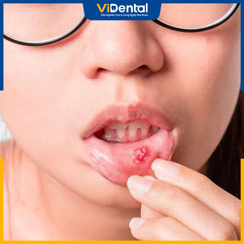 Biện pháp tự nhiên chữa nhiệt miệng cho trẻ