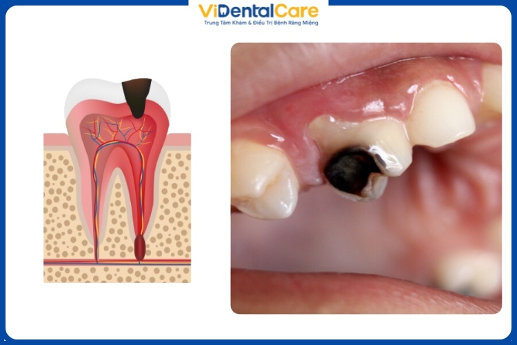 Bề mặt răng xuất hiện các lỗ sâu, đen