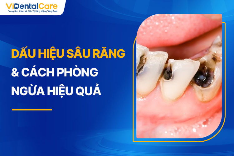 Dấu hiệu sâu răng hàm dưới