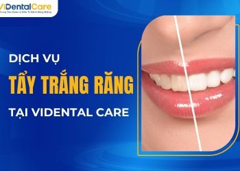 Dịch vụ tẩy trắng răng