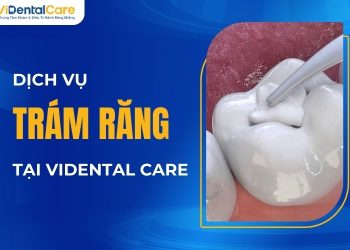 Dịch vụ trám răng tại VIDental Care