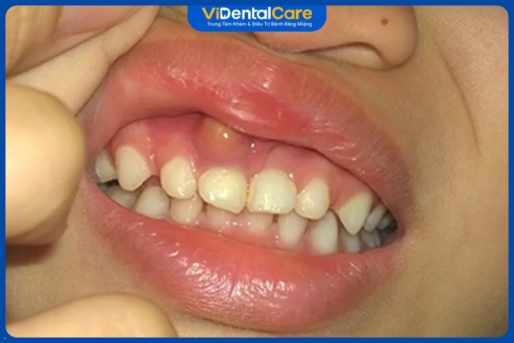 Viêm cha nha là bệnh lý răng miệng gặp ở mọi lứa tuổi