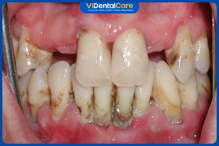 Viêm chu nha có thể gây mất răng