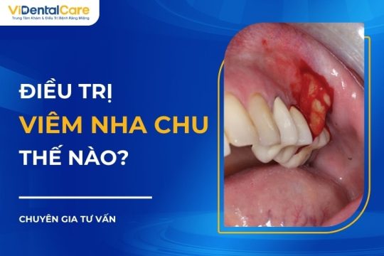 Điều trị viêm nha chu