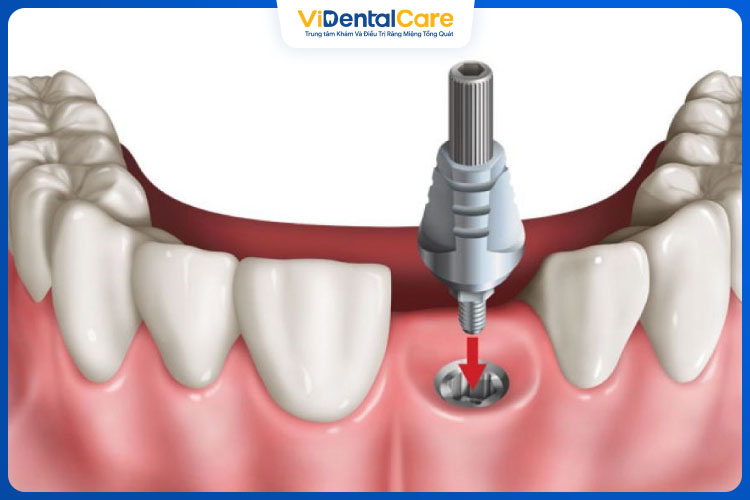 Nếu răng sâu quá nặng cần nhổ bỏ và phục hình răng giả