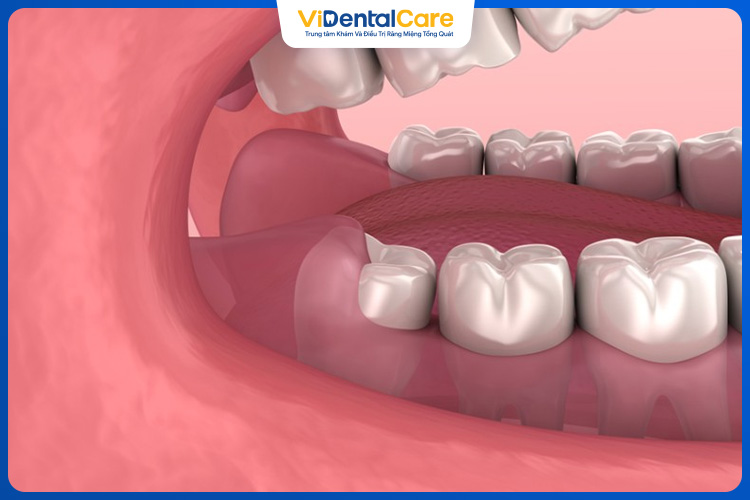 Răng khôn khỏe mạnh, không mọc lệch sẽ không cần nhổ bỏ