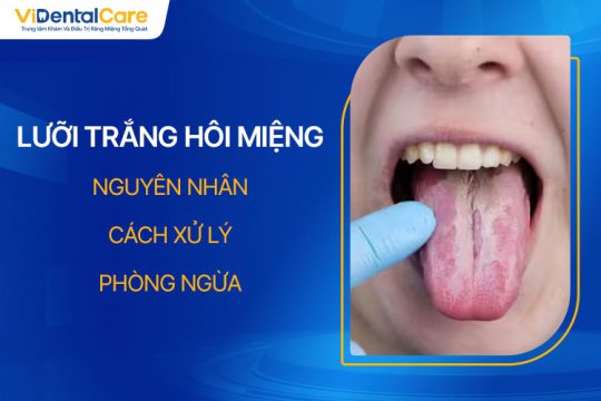 Lưỡi Trắng Hôi Miệng: Nguyên Nhân, Cách Xử Lý Tốt Nhất